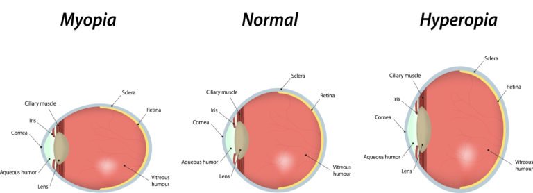 refractive-error-types-768x278